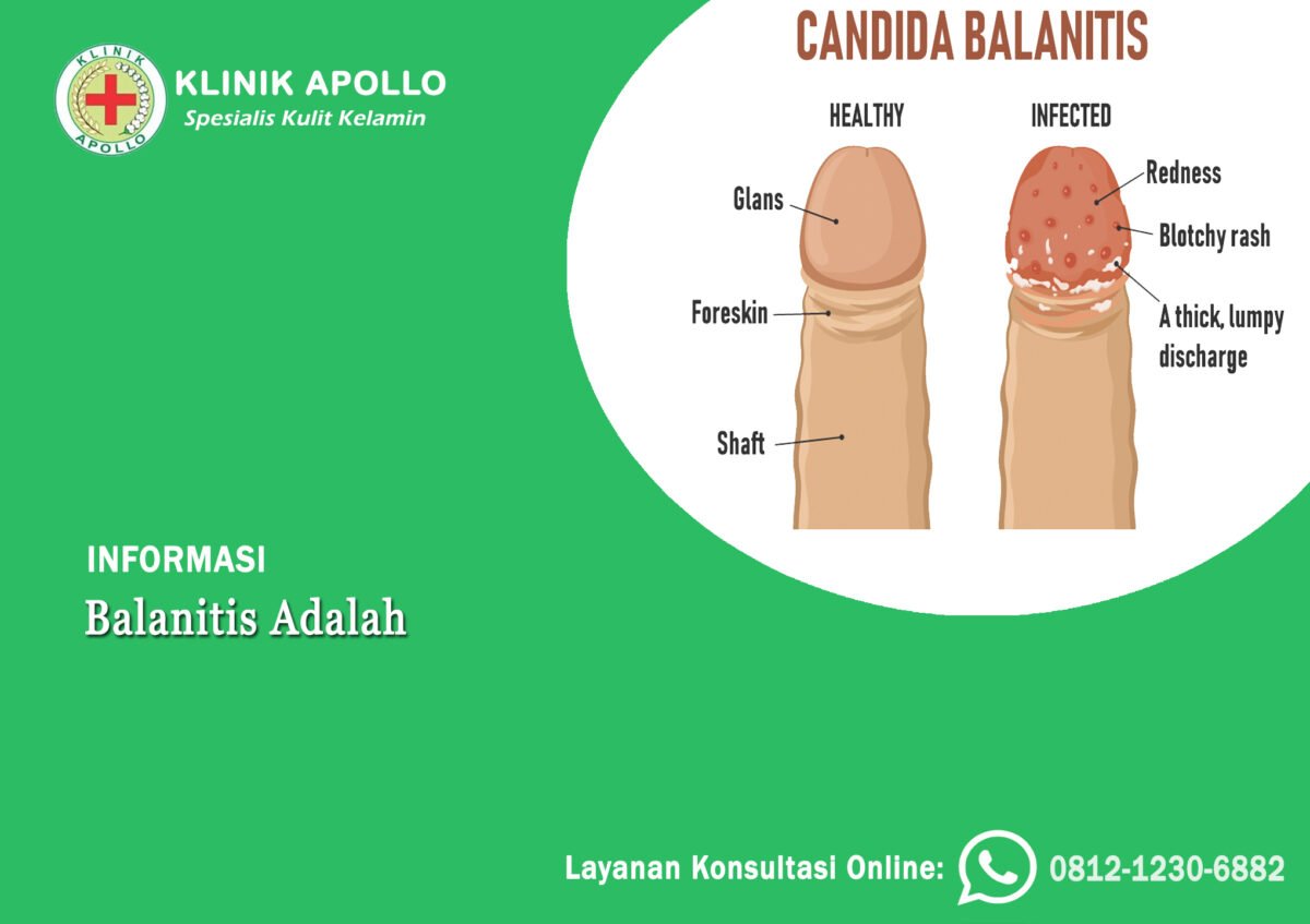 Balanitis Adalah Peradangan Pada Kepala Penis Klinik Apollo Jakarta