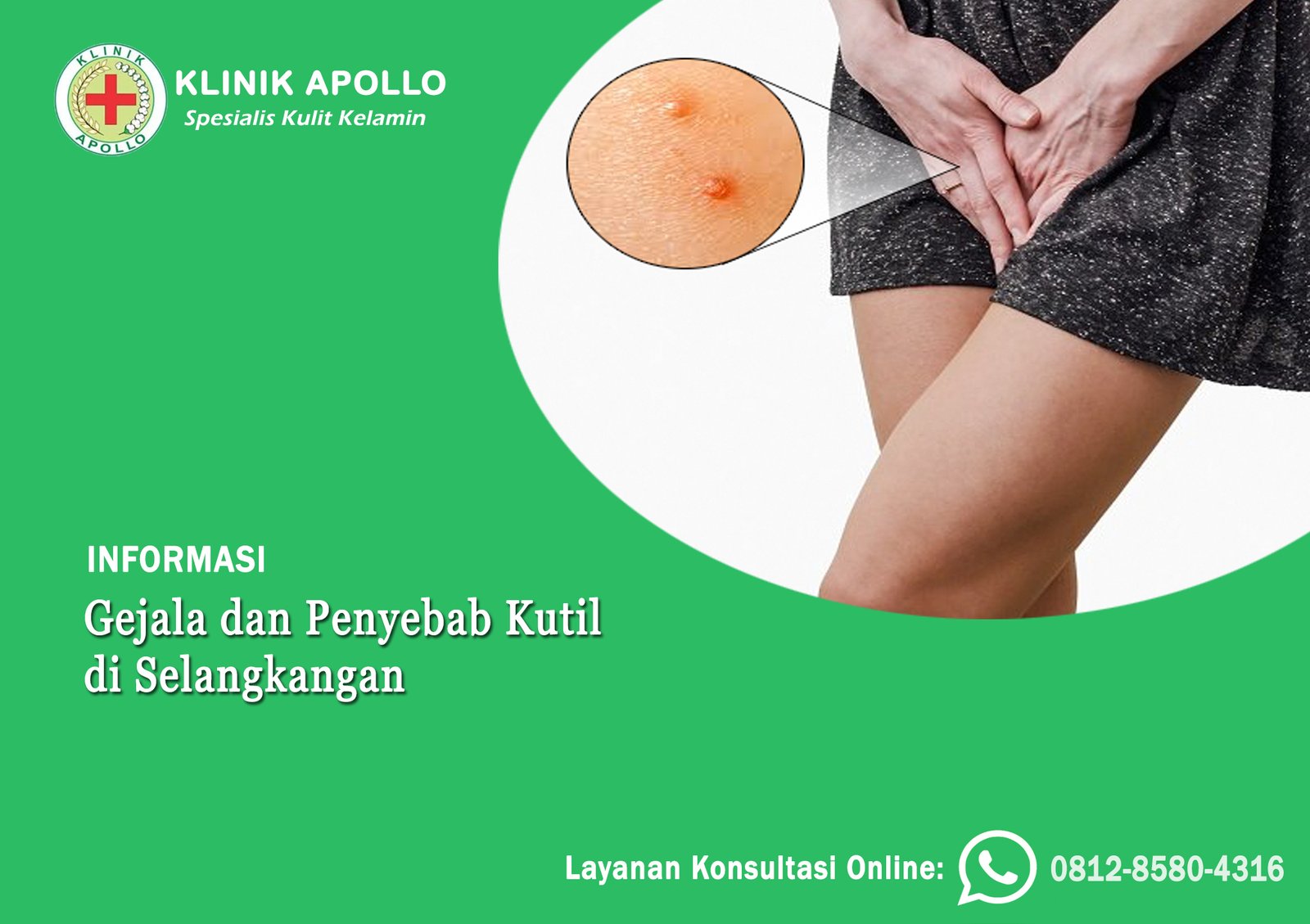 Ilustrasi Gejala dan Penyebab Kutil di Selangkangan