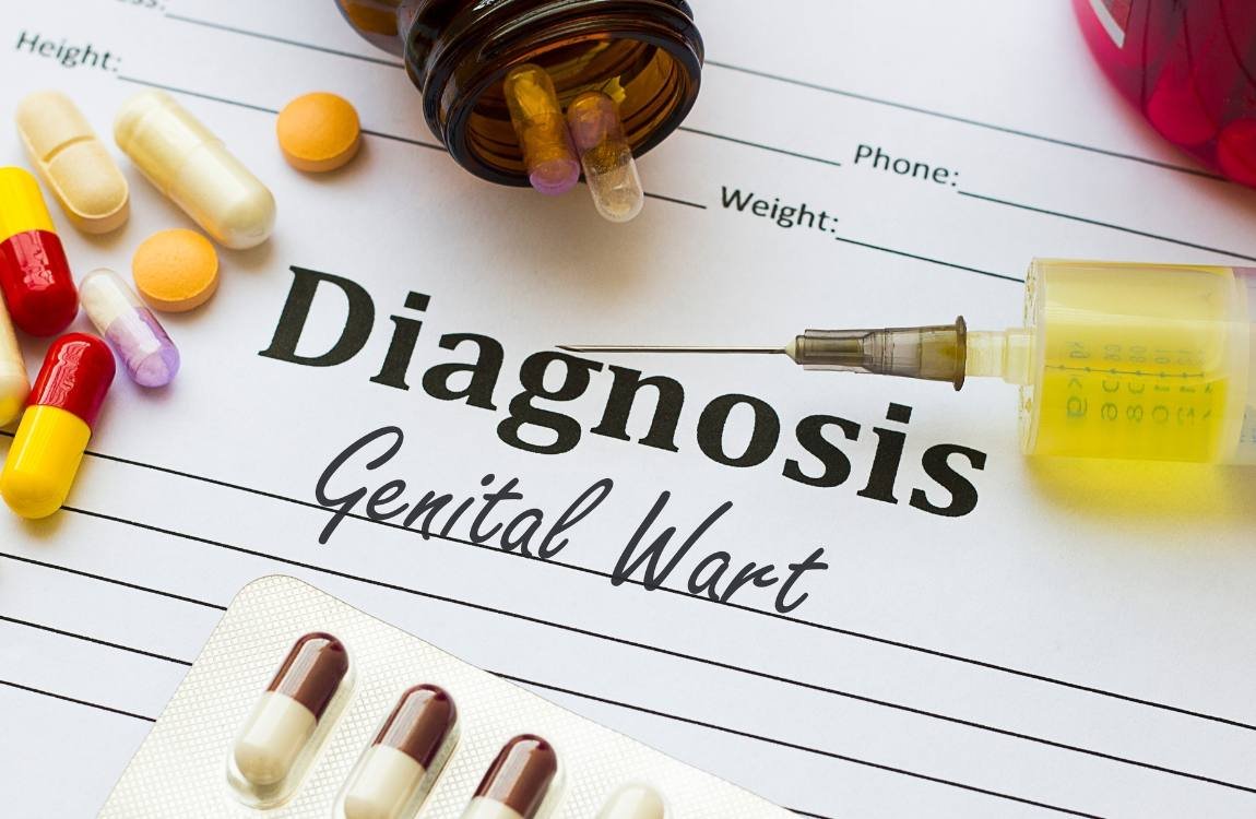 Ilustrasi Penyebab dan Gejala Kutil Kelamin