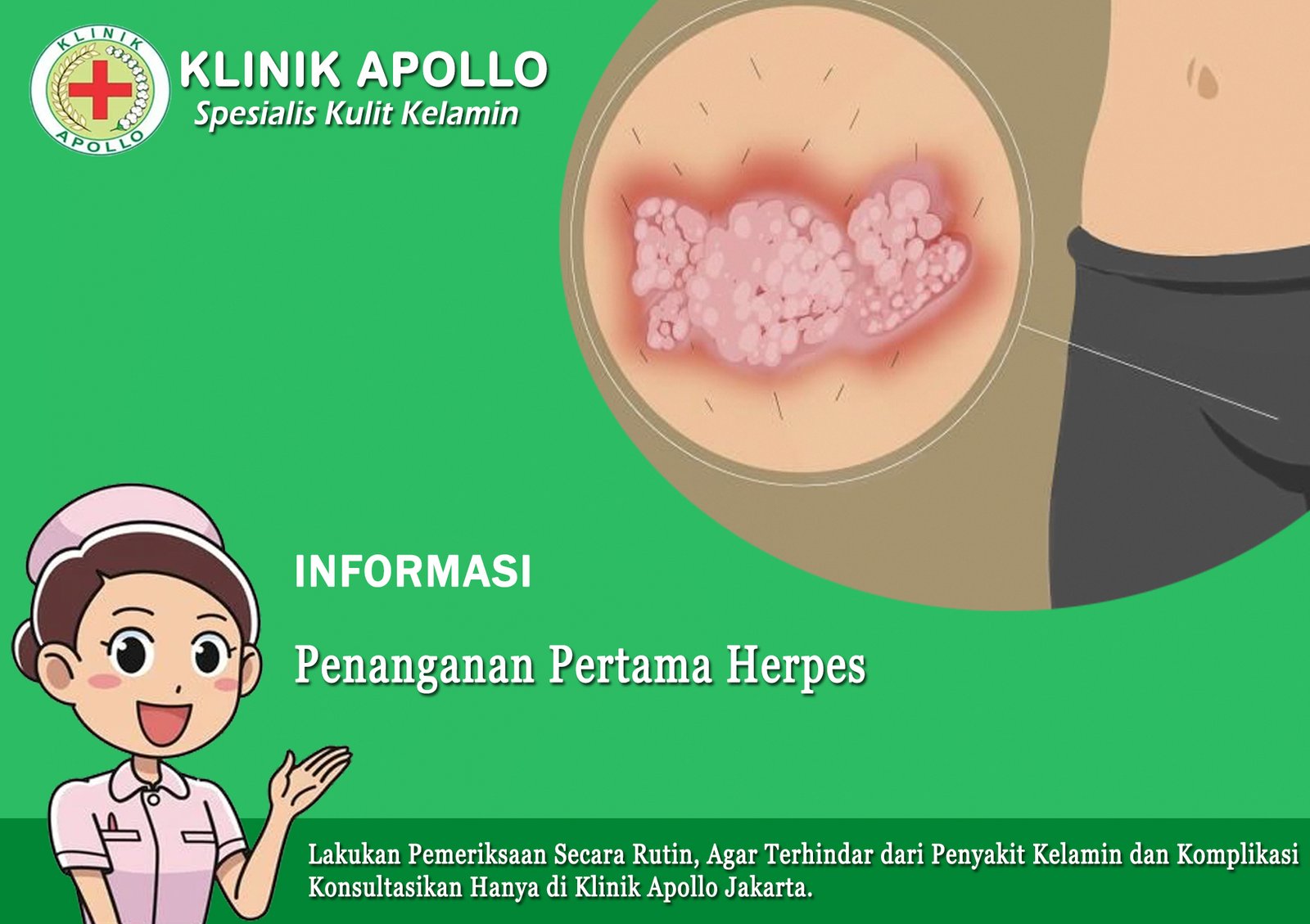 Penanganan Pertama Herpes
