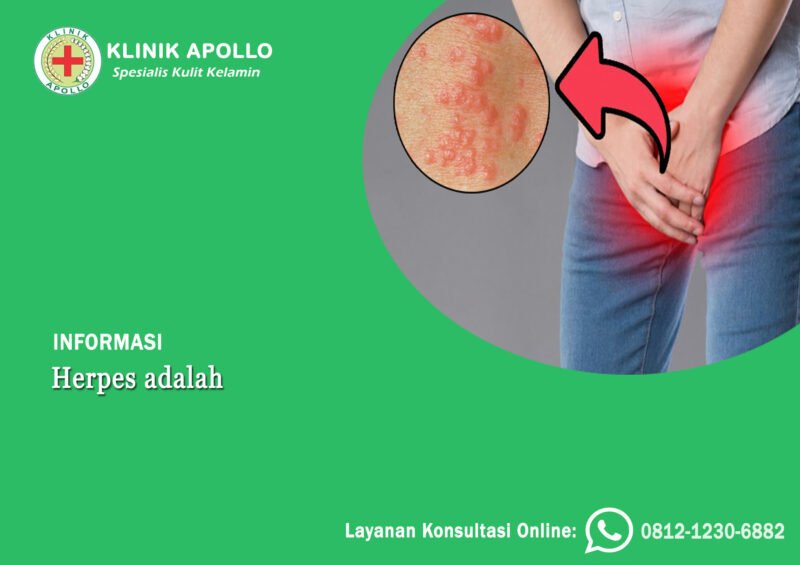 Herpes Adalah Infeksi Menular Seksual Akibat Virus Hsv Klinik Apollo