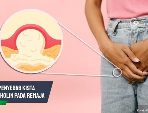 Cek! 6 Penyebab Kista Bartholin Remaja Dan Cara Menanganinya