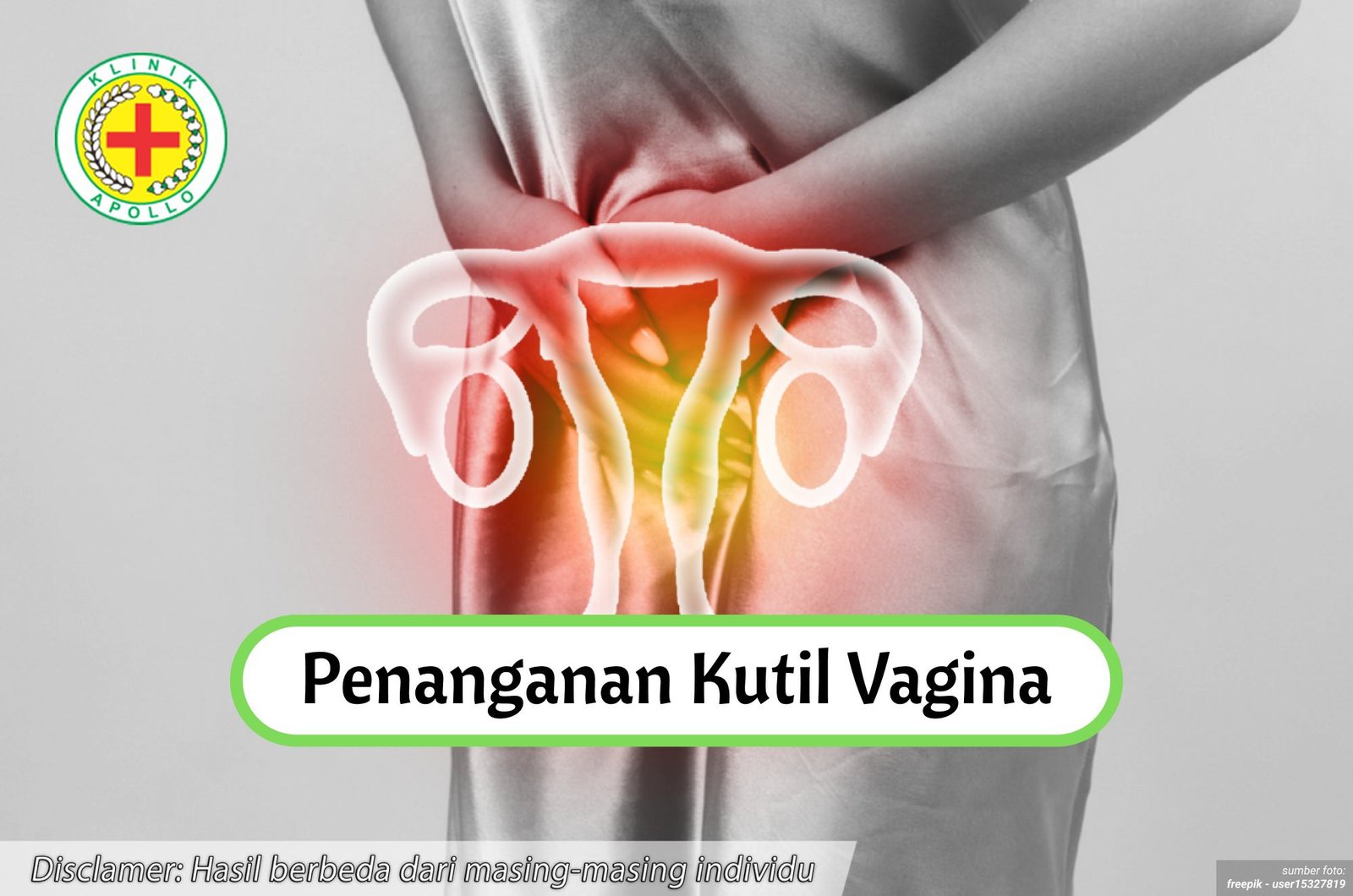 Ilustrasi Penanganan Kutil Vagina.