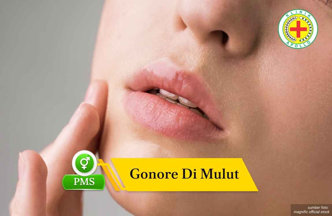 gonore di mulut Ilustrasi Gonore di Mulut.