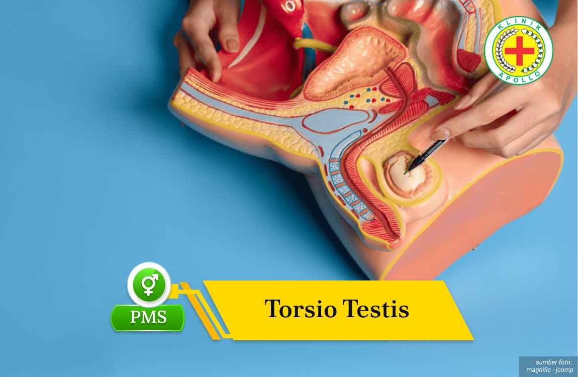 torsio testis Ilustrasi Torsio Testis.